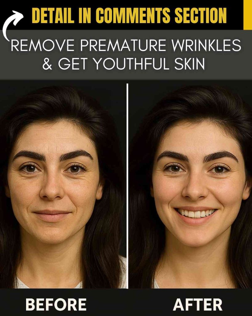 Here is your **1200+ word article** on the topic **"Remove Premature Wrinkles & Get Youthful Skin"** formatted for **WordPress** with proper **headings** as per your request: --- # Remove Premature Wrinkles & Get Youthful Skin with These Proven Home Remedies Premature wrinkles can appear as early as your 20s due to stress, poor diet, sun exposure, and lack of skin care. Thankfully, natural remedies can reverse the signs of aging when used consistently. Below are customized home remedies for each skin type that will help minimize wrinkles and restore youthful skin. --- ## 🟢 For Normal Skin: Wrinkle-Fighting Avocado & Aloe Blend ### ✅ 8 Ingredients with Quantity and Scientific Value 1. **Avocado (2 tablespoons)** – Rich in vitamin E and fatty acids that deeply nourish and repair skin. 2. **Aloe Vera Gel (1 tablespoon)** – Contains antioxidants like vitamin C and E to stimulate collagen production. 3. **Olive Oil (1 teaspoon)** – Hydrates skin and improves elasticity with oleic acid. 4. **Yogurt (1 tablespoon)** – Natural source of lactic acid that gently exfoliates and tightens skin. 5. **Vitamin E Capsule (1 capsule)** – Potent antioxidant that fights free radicals and smooths fine lines. 6. **Rose Water (1 teaspoon)** – Balances pH and provides a youthful glow. 7. **Honey (1 teaspoon)** – A natural humectant that hydrates and soothes skin. 8. **Cucumber Juice (1 teaspoon)** – Cools and tones skin while reducing puffiness. ### 📌 Procedure 1. Mix all ingredients in a bowl until you get a creamy paste. 2. Apply it evenly on your cleansed face and neck. 3. Leave it for 20–25 minutes. 4. Wash off with lukewarm water and pat dry. ### 📆 How Frequent to Apply Apply this remedy **3 times a week** for best results. ### ✨ Initial Results Skin appears smoother, plumper, and more hydrated after the first application. Fine lines start fading within 2 weeks. --- ## 🟢 For Combination Skin: Papaya & Turmeric Youth Mask ### ✅ 8 Ingredients with Quantity and Scientific Value 1. **Ripe Papaya (2 tablespoons)** – Contains papain enzyme that renews skin and reduces wrinkles. 2. **Turmeric (½ teaspoon)** – Curcumin in turmeric is anti-inflammatory and reduces signs of aging. 3. **Raw Milk (1 tablespoon)** – Exfoliates and moisturizes with lactic acid and calcium. 4. **Multani Mitti (Fuller’s Earth) (1 tablespoon)** – Absorbs excess oil while tightening pores. 5. **Almond Oil (1 teaspoon)** – Improves skin texture and reduces crow’s feet. 6. **Rose Water (1 teaspoon)** – Hydrates and balances oil zones. 7. **Sandalwood Powder (½ teaspoon)** – Soothes skin and reduces pigmentation. 8. **Honey (1 teaspoon)** – Adds moisture and elasticity to dry areas. ### 📌 Procedure 1. Mash papaya and mix in all other ingredients to form a smooth paste. 2. Apply evenly over face and neck. 3. Leave it for 20 minutes. 4. Rinse with cool water and dab dry. ### 📆 How Frequent to Apply Use this pack **twice a week** for visible improvement. ### ✨ Initial Results Skin feels fresh and balanced. Wrinkle depth reduces around combination zones within 2–3 applications. --- ## 🟢 For Oily Skin: Green Tea & Clay Detox Pack ### ✅ 8 Ingredients with Quantity and Scientific Value 1. **Green Tea (2 tablespoons brewed and cooled)** – Packed with antioxidants that fight skin aging. 2. **Bentonite Clay (1 tablespoon)** – Detoxifies and tightens sagging skin. 3. **Lemon Juice (½ teaspoon)** – Vitamin C boosts collagen and fades wrinkles. 4. **Cucumber Pulp (1 tablespoon)** – Hydrates oily skin and cools inflammation. 5. **Honey (1 teaspoon)** – Prevents excessive dryness while controlling oil. 6. **Aloe Vera Gel (1 tablespoon)** – Moisturizes without clogging pores. 7. **Vitamin C Powder (½ teaspoon)** – Boosts skin regeneration and reduces pigmentation. 8. **Tea Tree Oil (2 drops)** – Controls oil and keeps skin clear of acne-related aging. ### 📌 Procedure 1. Combine all ingredients into a thick paste. 2. Apply on the face focusing on T-zone. 3. Let it sit for 15–20 minutes. 4. Wash with cold water. ### 📆 How Frequent to Apply Use **every 3 days** to tighten skin and control excess oil. ### ✨ Initial Results Face looks visibly brighter and less oily. With regular use, wrinkles around oily areas reduce significantly. --- ## 🟢 For Dry Skin: Banana & Cream Hydration Mask ### ✅ 8 Ingredients with Quantity and Scientific Value 1. **Banana (½ ripe banana mashed)** – Rich in potassium and vitamins A & E that moisturize and soften skin. 2. **Fresh Cream (1 tablespoon)** – High-fat content intensely hydrates and repairs dry lines. 3. **Honey (1 teaspoon)** – Locks moisture and adds elasticity. 4. **Almond Powder (1 teaspoon)** – Gently exfoliates and nourishes with vitamin E. 5. **Glycerin (½ teaspoon)** – Deep hydrator that keeps skin supple. 6. **Rose Water (1 teaspoon)** – Adds a soothing, cooling effect. 7. **Flaxseed Gel (1 tablespoon)** – Contains omega-3s that tighten and tone. 8. **Olive Oil (1 teaspoon)** – Replenishes natural oils and prevents wrinkle formation. ### 📌 Procedure 1. Mix all ingredients into a smooth mask. 2. Apply generously to your face and neck. 3. Leave it for 25–30 minutes. 4. Rinse with warm water. ### 📆 How Frequent to Apply Apply **3 times weekly**, especially in colder months. ### ✨ Initial Results Skin feels instantly plumped and moisturized. Noticeably fewer cracks and wrinkles after 1 week. --- ## 🟢 For Sensitive Skin: Chamomile & Oat Calming Mask ### ✅ 8 Ingredients with Quantity and Scientific Value 1. **Chamomile Tea (2 tablespoons brewed)** – Anti-inflammatory properties calm irritated skin. 2. **Oatmeal (1 tablespoon ground)** – Soothes sensitive skin and provides light exfoliation. 3. **Honey (1 teaspoon)** – Heals micro-damage and moisturizes. 4. **Yogurt (1 tablespoon)** – Contains probiotics and lactic acid to gently renew skin. 5. **Aloe Vera (1 tablespoon)** – Hydrates and reduces redness. 6. **Coconut Oil (½ teaspoon)** – Fights free radicals and smooths fine lines. 7. **Cucumber Juice (1 teaspoon)** – Refreshes and cools skin. 8. **Rose Water (1 teaspoon)** – Gentle toner suitable for sensitive skin. ### 📌 Procedure 1. Blend ingredients to form a creamy texture. 2. Apply a light layer over clean skin. 3. Let it sit for 15–20 minutes. 4. Wipe gently with a soft wet cloth. ### 📆 How Frequent to Apply Use **twice a week** for wrinkle prevention without irritation. ### ✨ Initial Results Soothes redness and softens skin instantly. Gradual reduction in wrinkle appearance after 2–3 uses. --- # 🍽 Weekly Day-Wise Diet Plan for Fairness & Healthy Skin A wrinkle-free face starts from within. Follow this antioxidant-rich vegetarian and non-vegetarian mix diet to promote fairness and slow aging. ### 🗓 Monday **Breakfast**: Oats with almonds and berries **Lunch**: Brown rice + spinach curry **Dinner**: Grilled chicken + boiled broccoli + carrot soup ### 🗓 Tuesday **Breakfast**: Green smoothie (spinach + banana + flaxseeds) **Lunch**: Mixed vegetable dal + chapati **Dinner**: Salmon + quinoa + cucumber salad ### 🗓 Wednesday **Breakfast**: Greek yogurt + honey + chia seeds **Lunch**: Rajma curry + rice + beetroot salad **Dinner**: Egg curry + sautéed veggies ### 🗓 Thursday **Breakfast**: Poha + coconut water **Lunch**: Paneer tikka + cucumber raita **Dinner**: Chicken stew + brown bread ### 🗓 Friday **Breakfast**: Boiled eggs + papaya slices **Lunch**: Vegetable khichdi + curd **Dinner**: Fish curry + mixed grain roti ### 🗓 Saturday **Breakfast**: Avocado toast + herbal tea **Lunch**: Tofu stir fry + rice noodles **Dinner**: Grilled prawns + spinach puree ### 🗓 Sunday **Breakfast**: Almond milk smoothie **Lunch**: Vegetable pulao + carrot-cucumber salad **Dinner**: Mutton soup + roasted veggies --- With these remedies and a nourishing diet, you can reverse premature wrinkles and enjoy naturally youthful, glowing skin. Be consistent, and you’ll see visible transformation within weeks. Would you like this content turned into a video or infographic for your blog or YouTube?