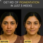 Home Remedies to Get Rid of Pigmentation in Just 3 Weeks