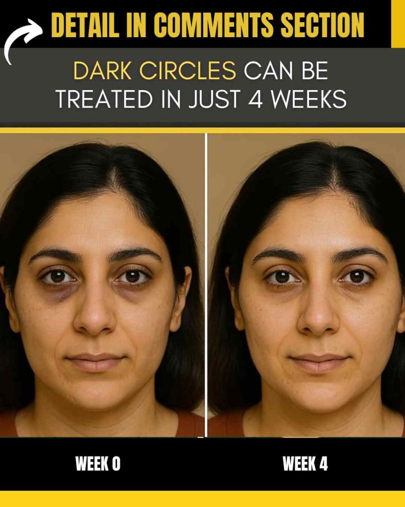 DARK CIRCLES CAN BE TREATED IN JUST 4 WEEKS