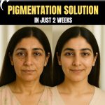 Pigmentation Solution in Just 2 Weeks with These Home Remedies