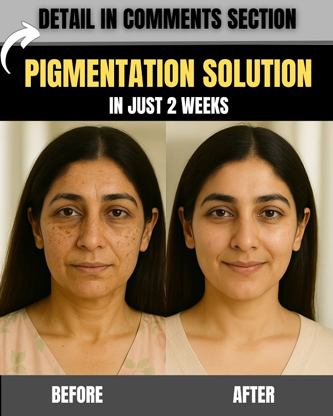 Pigmentation Solution in Just 2 Weeks with These Home Remedies