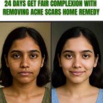 24 DAYS GET FAIR COMPLEXION WITH REMOVING ACNE SCARS – HOME REMEDY BY SKIN TYPE