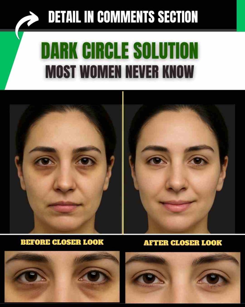 Dark Circle Solution Most Women Never Know (With Complete Diet Plan for Diabetic and Non-Diabetic)