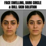 Face Swelling, Dark Circle & Dull Skin Solution