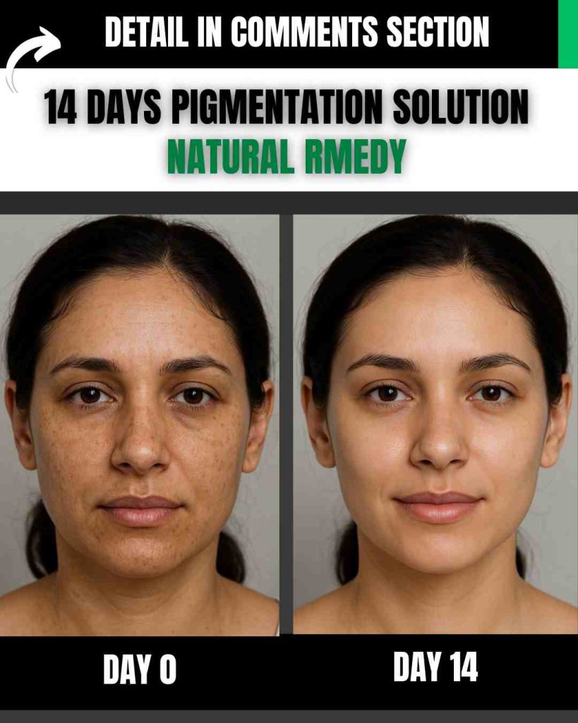 14 Days Pigmentation Solution – Natural Remedy with Diet Plan