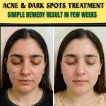 ACNE & DARK SPOTS TREATMENT — SIMPLE REMEDY RESULT IN FEW WEEKS
