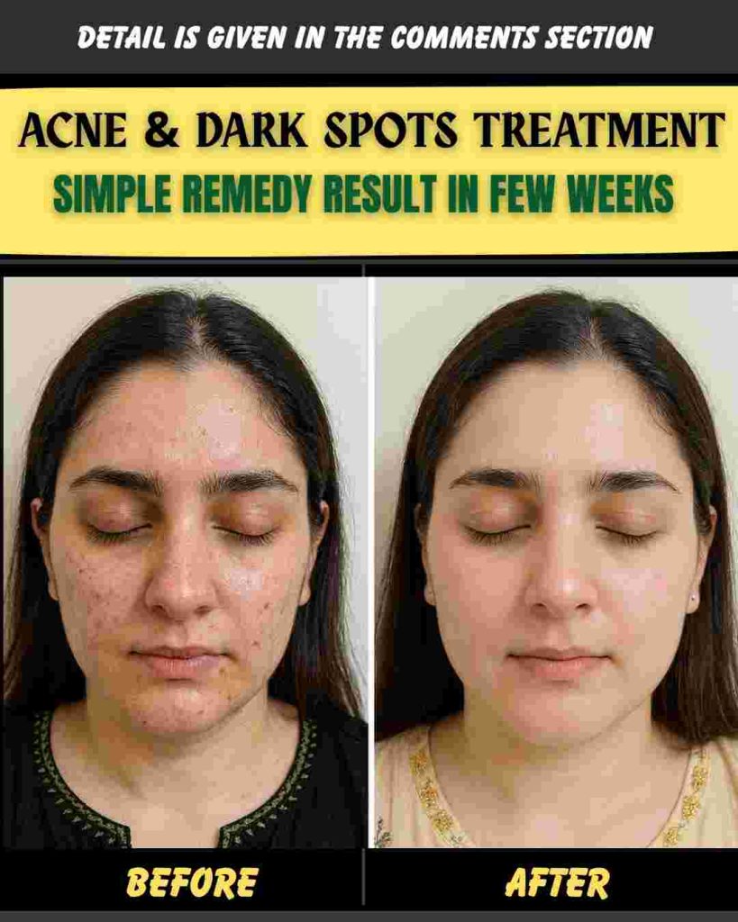 ACNE & DARK SPOTS TREATMENT — SIMPLE REMEDY RESULT IN FEW WEEKS