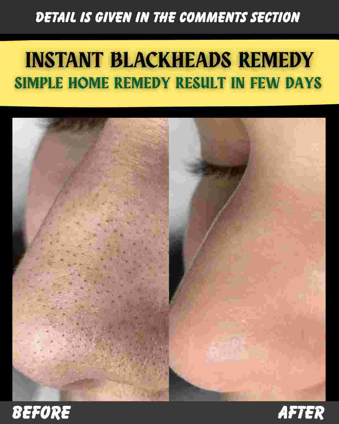BLACKHEADS REMOVAL REMEDY – SIMPLE HOME REMEDY WITH RESULTS IN FEW DAYS