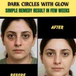 DARK CIRCLES WITH GLOW – SIMPLE REMEDY RESULT IN FEW WEEKS