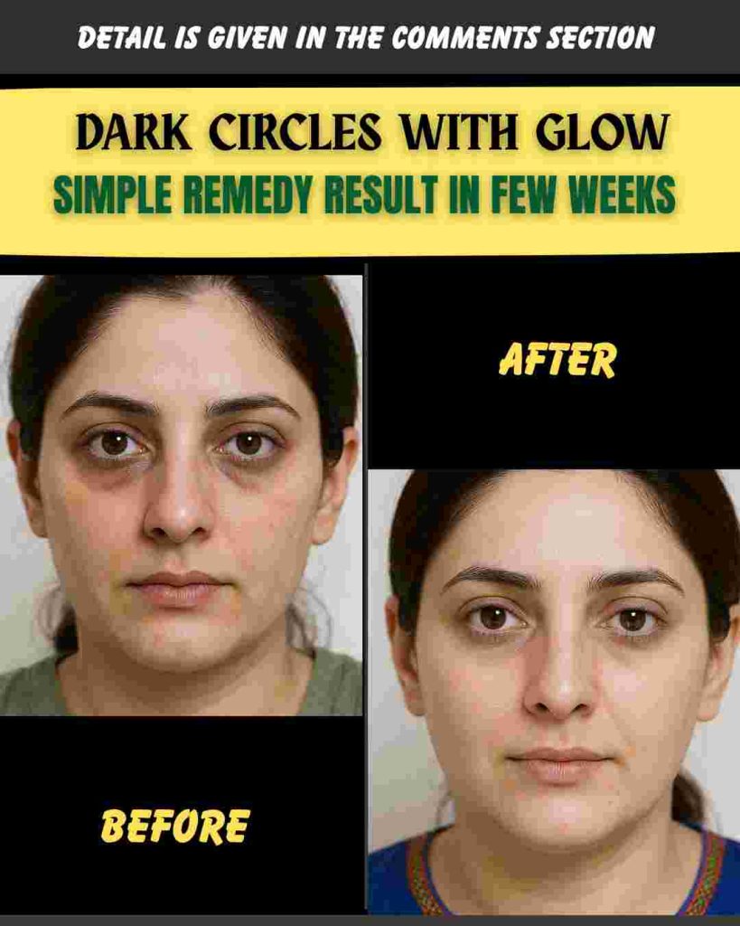 DARK CIRCLES WITH GLOW – SIMPLE REMEDY RESULT IN FEW WEEKS