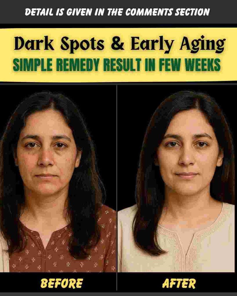 DARK SPOTS & EARLY AGING – SIMPLE REMEDY RESULT IN FEW WEEKS