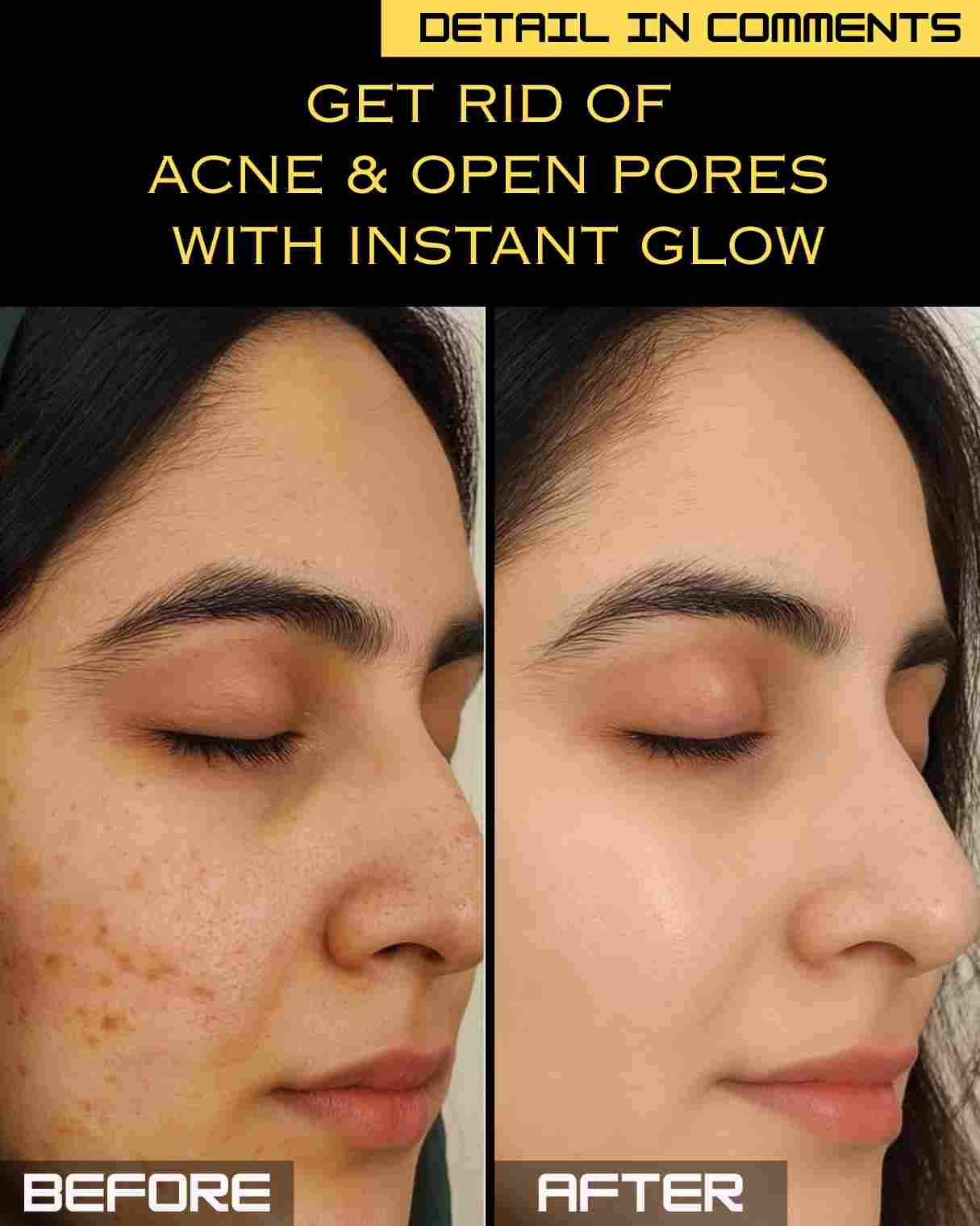 Get Rid of Acne & Open Pores with Instant Natural Glow – Remedies by Skin Type