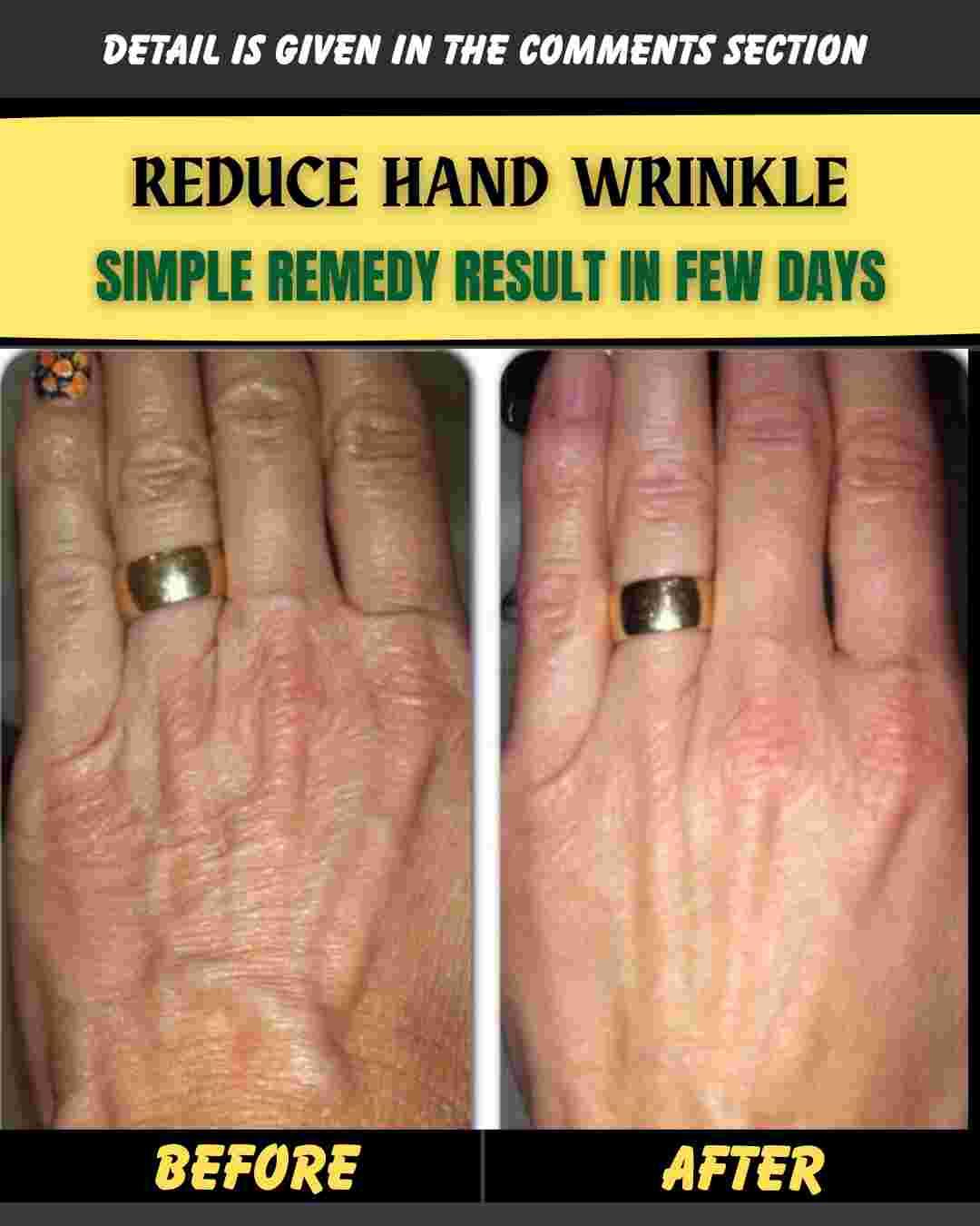 REDUCE HAND WRINKLES – SIMPLE REMEDY WITH RESULTS IN FEW DAYS
