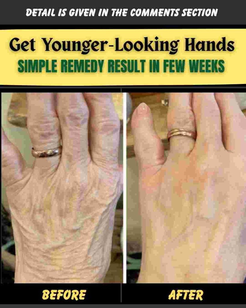 GET YOUNGER-LOOKING HANDS – SIMPLE REMEDIES RESULT IN FEW WEEKS