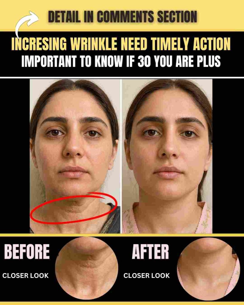 Increasing Wrinkles Need Timely Action – What Every 30+ Must Know