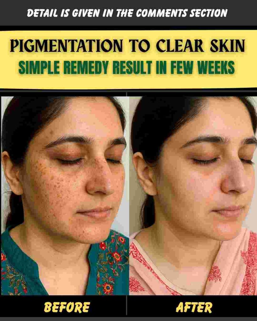 PIGMENTATION TO CLEAR SKIN – SIMPLE REMEDY RESULT IN FEW WEEKS