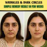 WRINKLES & DARK CIRCLES SIMPLE REMEDY – RESULT IN FEW WEEKS