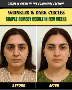 WRINKLES & DARK CIRCLES SIMPLE REMEDY – RESULT IN FEW WEEKS