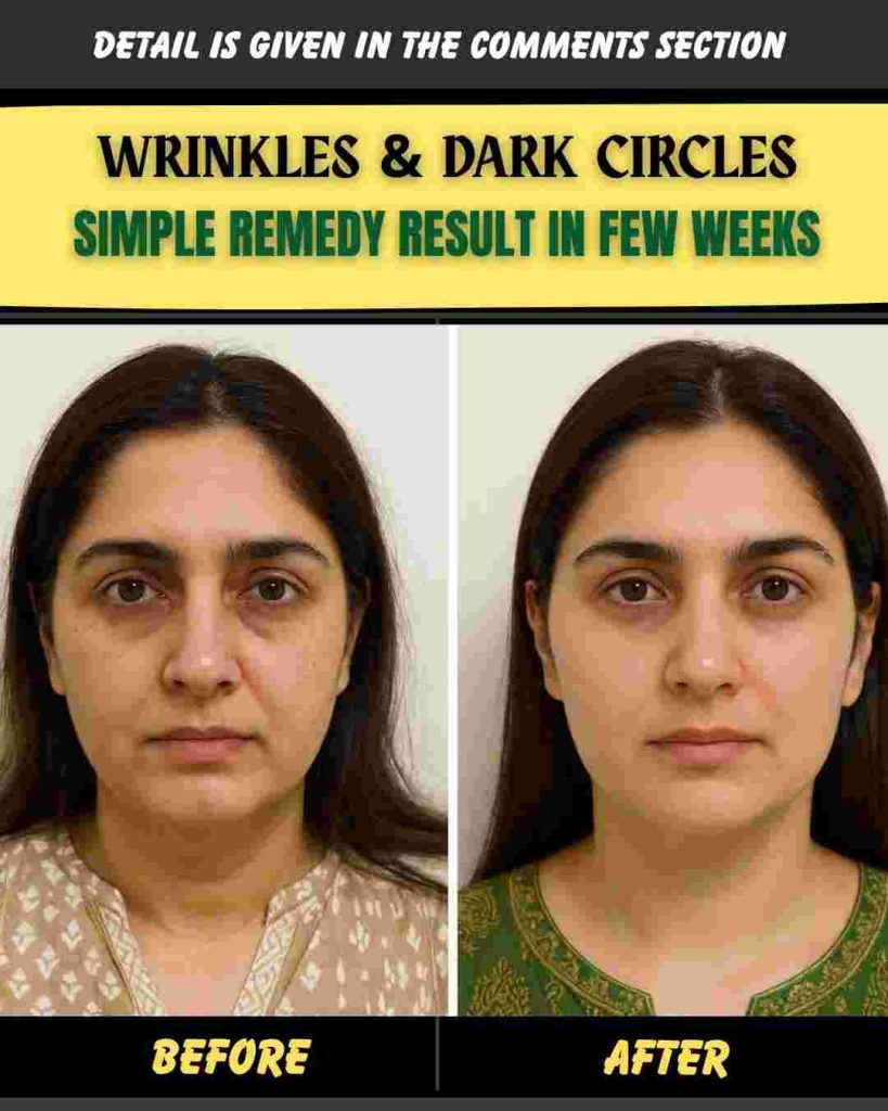 WRINKLES & DARK CIRCLES SIMPLE REMEDY – RESULT IN FEW WEEKS