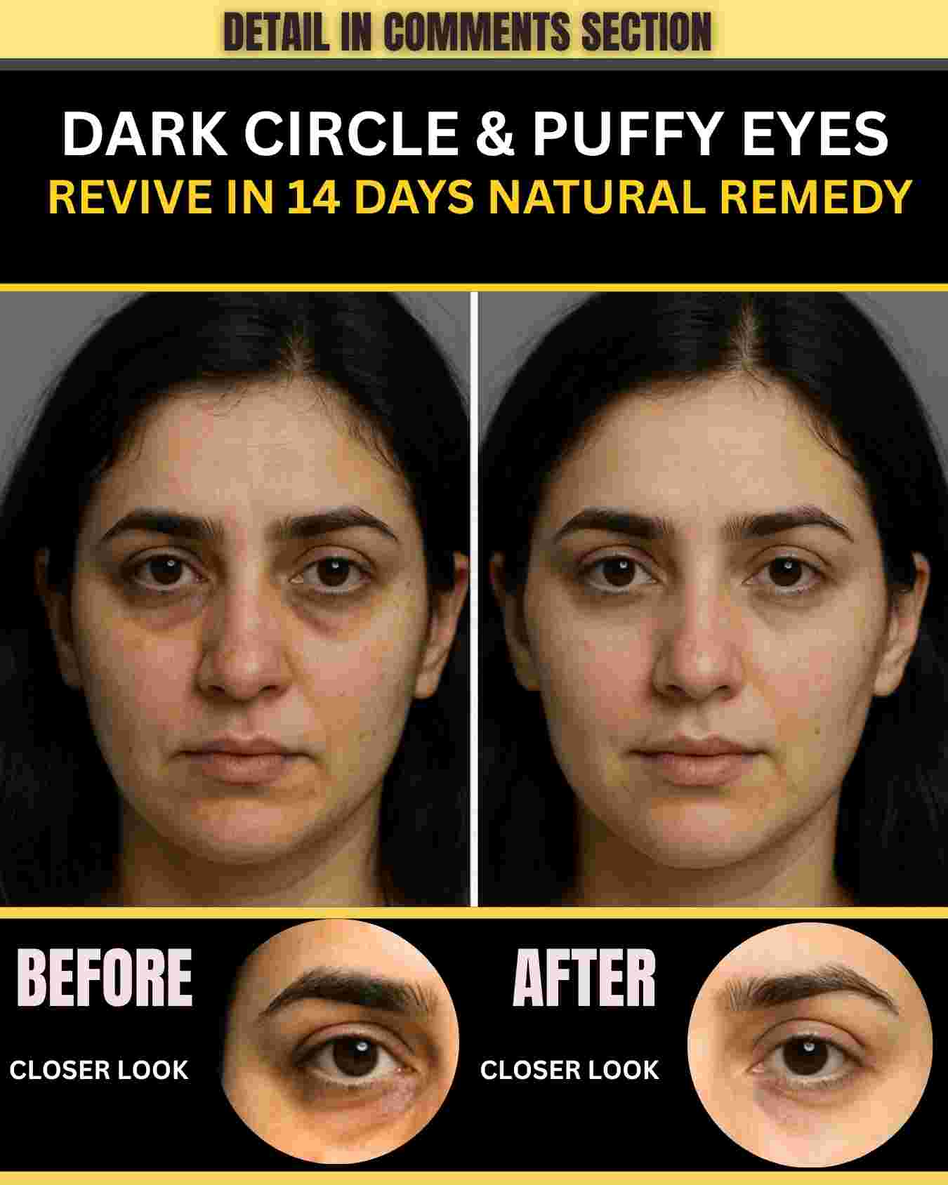 DARK CIRCLE & PUFFY EYES – SIMPLE NATURAL SOLUTION