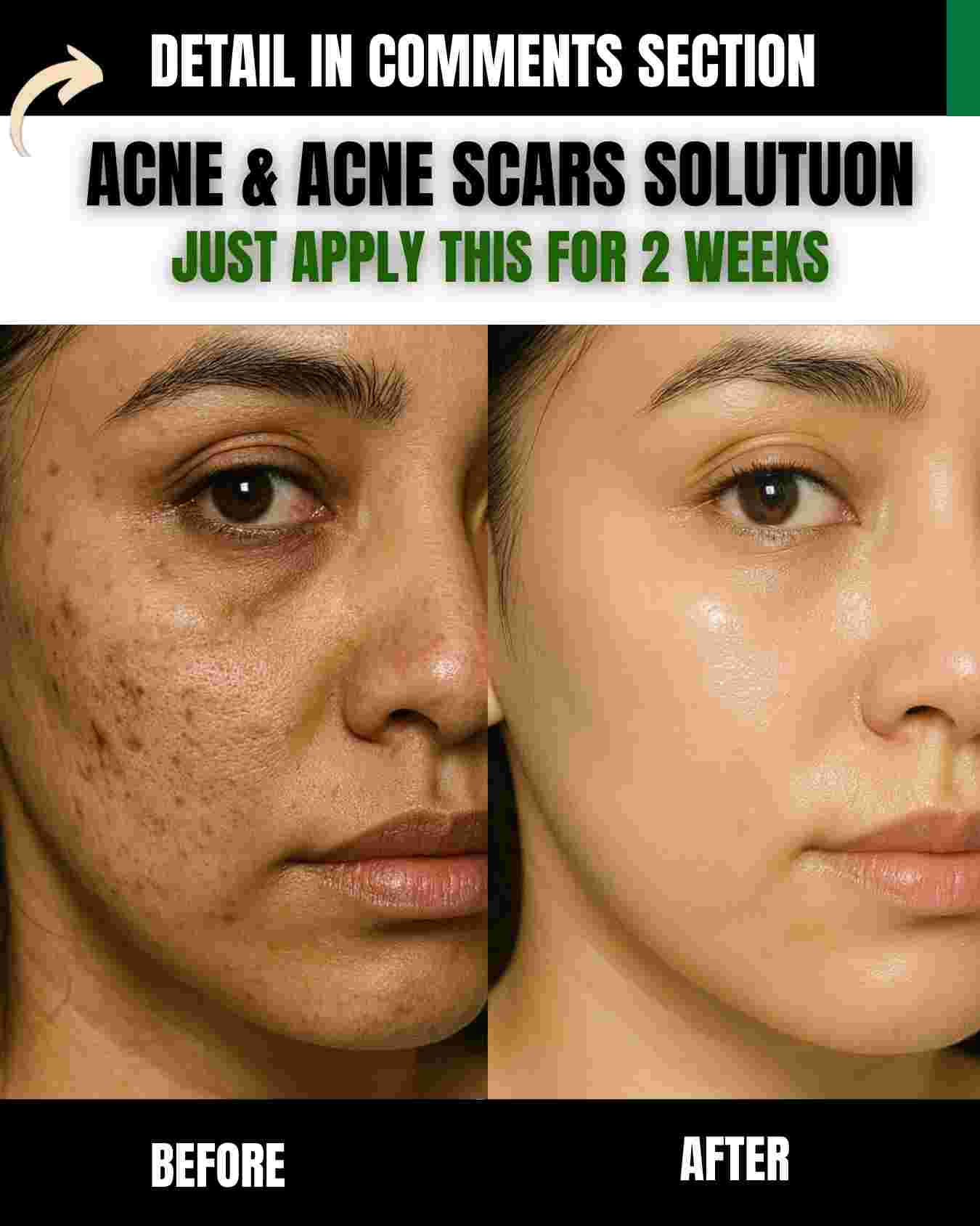 ACNE & ACNE SCARS SOLUTUON