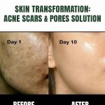 ACNE SCARS & OPEN PORES SOLUTION – NATURAL REMEDIES BY SKIN TYPE