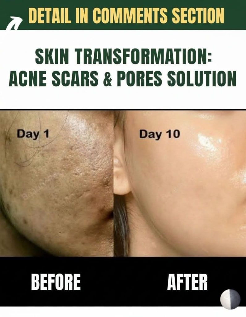 ACNE SCARS & OPEN PORES SOLUTION – NATURAL REMEDIES BY SKIN TYPE