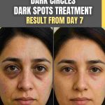 Dark Circles & Dark Spots Treatment – Visible Results from Day 7