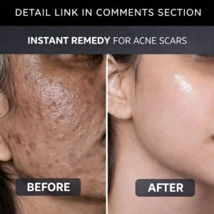 INSTANT REMEDY FOR ACNE SCARS – NATURAL SOLUTION