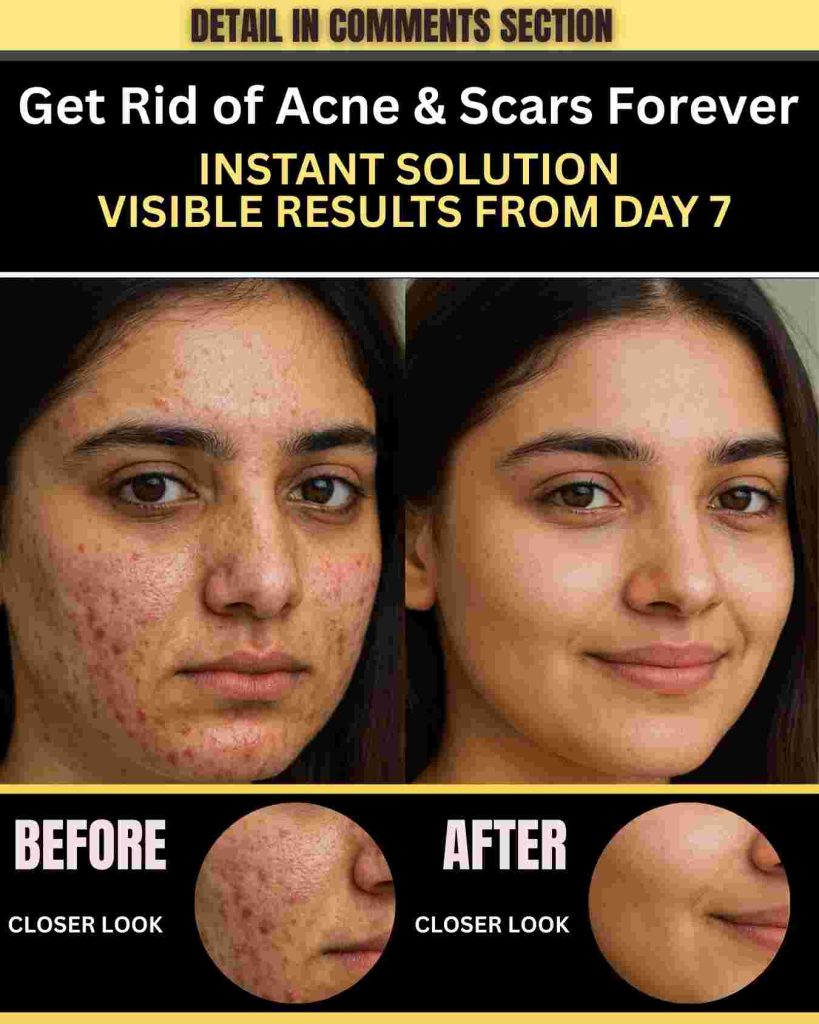 GET RID OF ACNE & SCARS FOREVER – INSTANT SOLUTION (VISIBLE RESULTS FROM DAY 7)