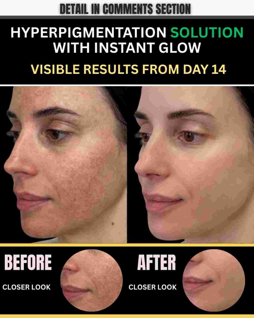 Hyperpigmentation Solution With Instant Glow Visible Results From Day 21