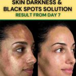 SKIN DARKNESS & BLACK SPOTS SOLUTION