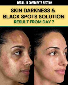 SKIN DARKNESS & BLACK SPOTS SOLUTION
