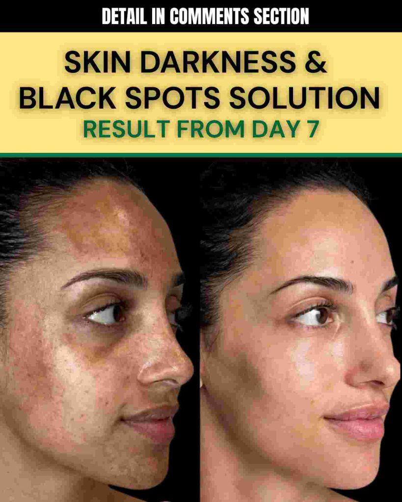 SKIN DARKNESS & BLACK SPOTS SOLUTION