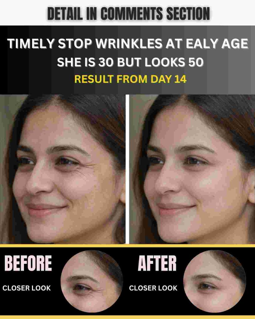 Timely Stop Wrinkles at Early Age – She Is 30 but Looks 50 (Results from Day 14)
