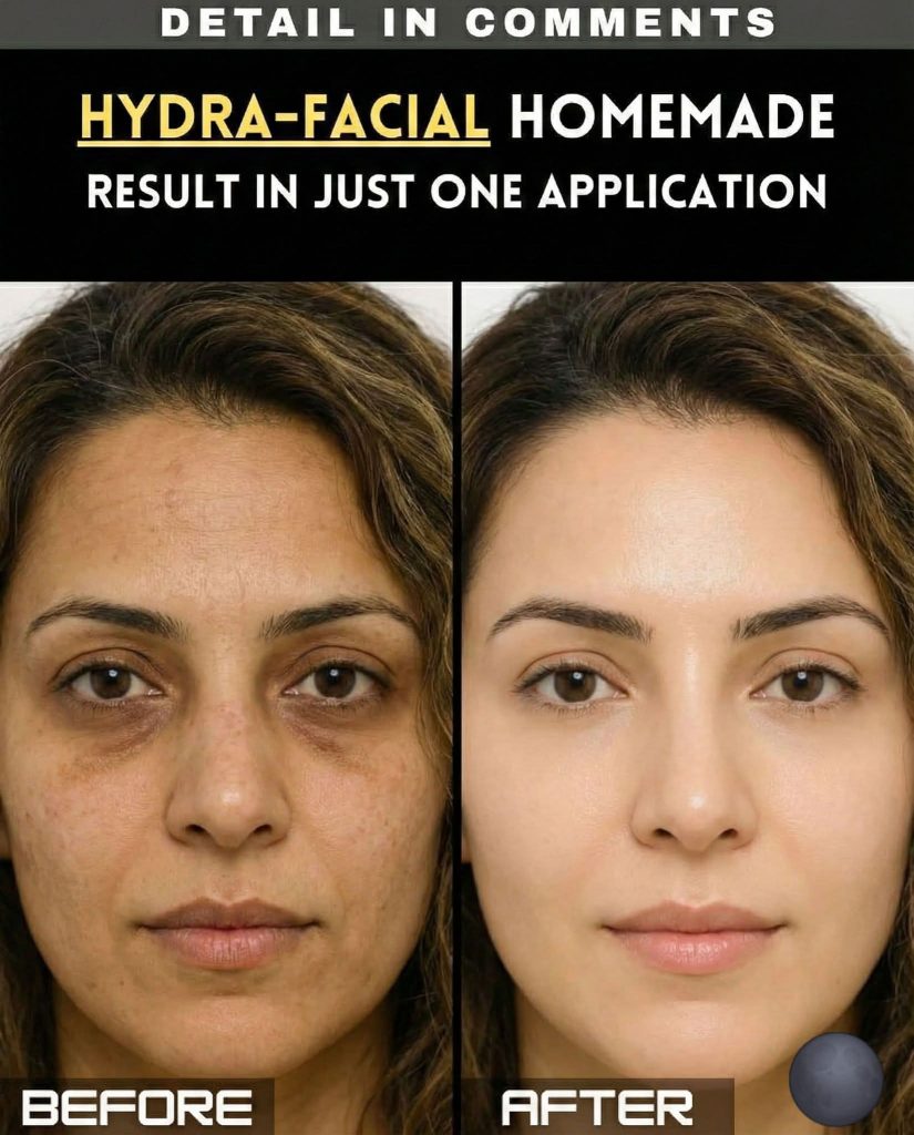 Hydra-Like Facial Using Home Remedies for Glowing Skin