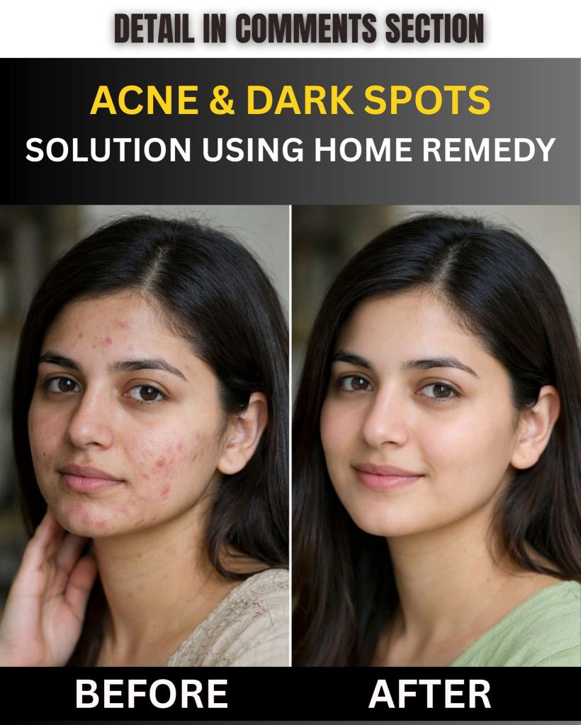 Acne and Dark Spots Solution Using Home Remedies (By Skin Type)