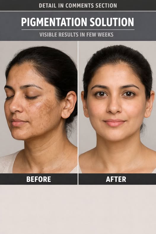 Before You Try Laser Pigmentation Treatment, Consider This Natural Home Remedy First