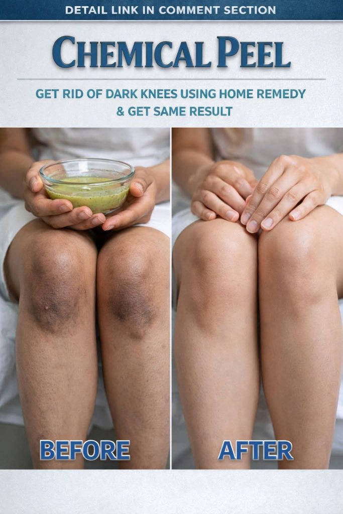 Get Rid of Dark Knees Naturally at Home