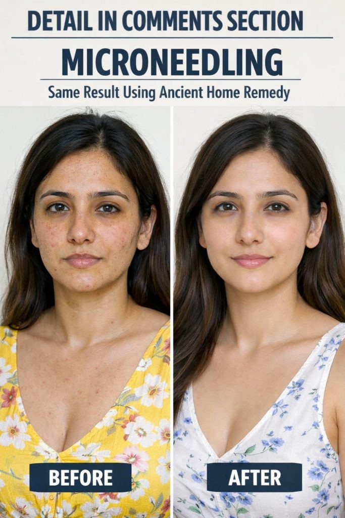 MICRONEEDLING GLOW AT HOME – SAME RESULT USING ANCIENT NATURAL REMEDIES