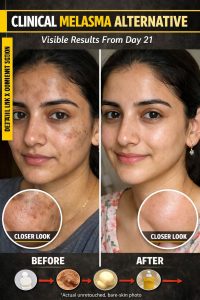 Natural Melasma Reduction Remedies for Clear Skin