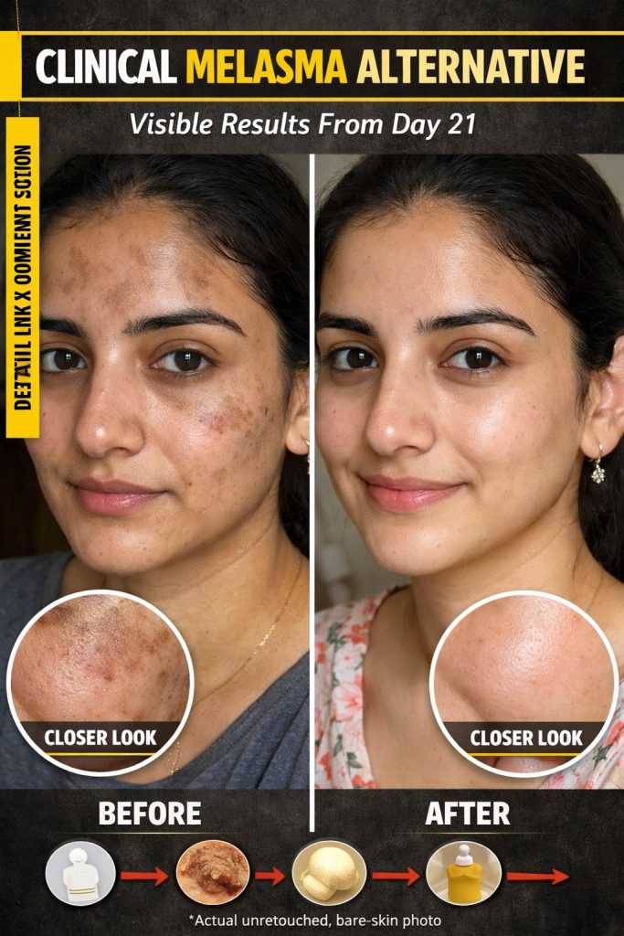 Natural Melasma Reduction Remedies for Clear Skin