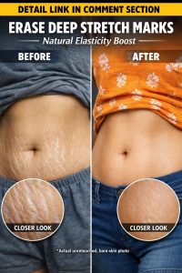 Natural Ways to Reduce Stretch Marks and Restore Skin Elasticity