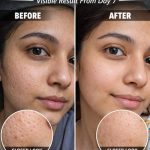 Effective Natural Remedies to Minimize Open Pores Fast