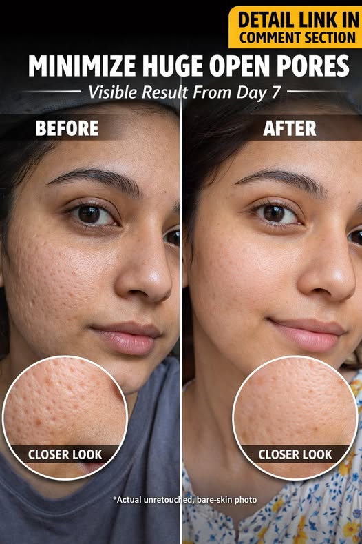 Effective Natural Remedies to Minimize Open Pores Fast