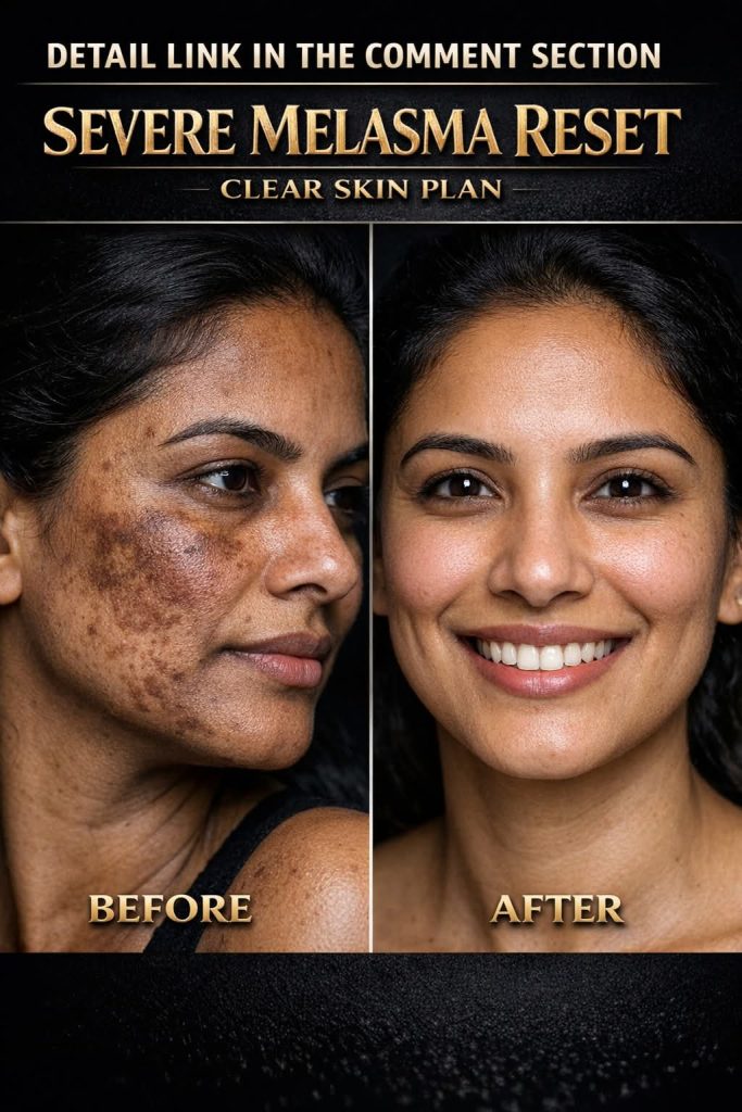 Severe Melasma Reset: Clear Skin Plan to Remove Dark Patches Naturally by Skin Type