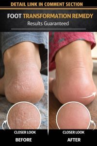 Powerful Natural Remedies to Heal Cracked Heels Fast