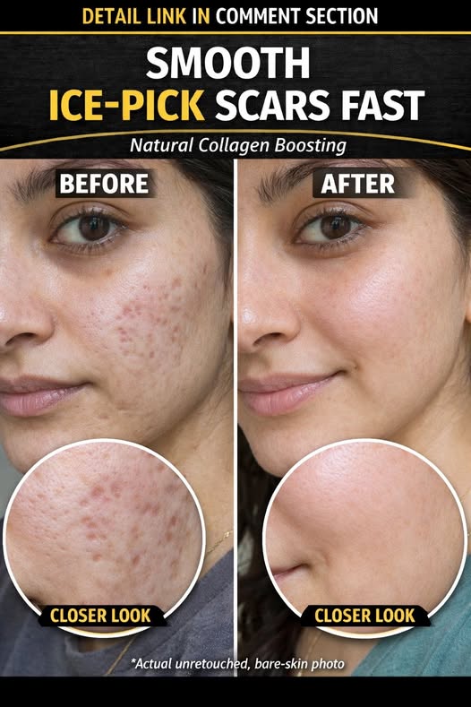 Fast Natural Ways to Smooth Ice Pick Scars