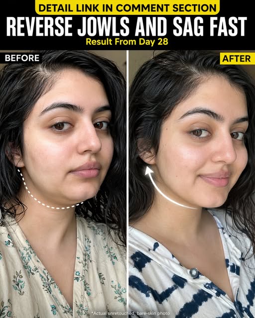 Natural Ways to Lift Sagging Jawline Fast