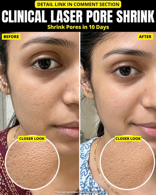 Natural Ways to Tighten Enlarged Facial Pores Fast